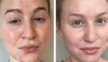 7 błędów w pielęgnacji twarzy, które sprzyjają powstawaniu wyprysków