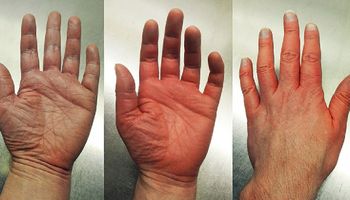 jak powstrzymać starzenie się dłoni