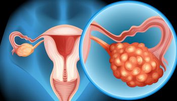 5 wczesnych oznak raka jajnika. Jest w stanie dostrzec je każda kobieta