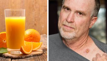 Sok pomarańczowy może zwiększać ryzyko raka skóry o ponad 50%. Winowajcą obecna w nim substancja