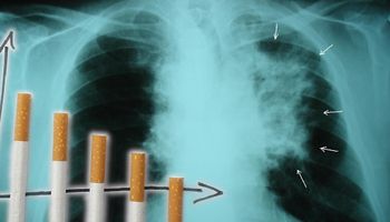 Rak płuc u osób, które nigdy nie paliły. Naukowcy coraz bliżej znalezienia przyczyn choroby