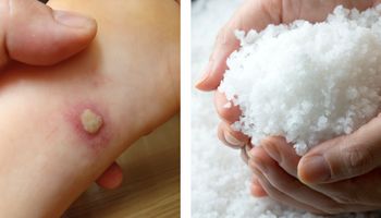 5 schorzeń które wyleczysz stosując opatrunki solne. To prosta i tania metoda naszych dziadków