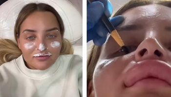 23-latka usunęła wypełniacz z ust. Efekt ją przeraził