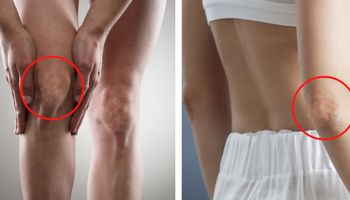 „Brudne łokcie i kolana” mogą być objawem problemów z tarczycą