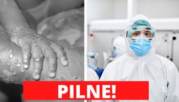 Czy małpia ospa jest już w Polsce? Mamy najnowsze informacje w tej sprawie