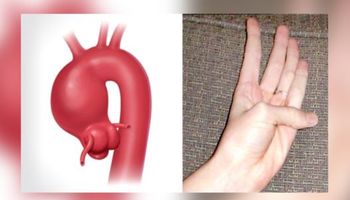 Prosty test kciuka, który pomoże sprawdzić czy w Twoim ciele znajduje się tętniak