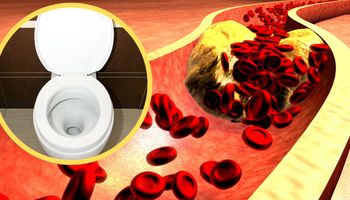 Pierwszy objaw zbyt wysokiego poziomu cholesterolu możesz zauważyć w toalecie