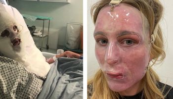W wyniku nieszczęśliwego wypadku, jej twarz się stopiła. Kobieta musiała nosić plastikową maskę