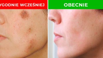Naturalne sposoby na pozbycie się przebarwień skóry. Działają jak gumka do mazania