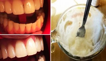 Domowy sposób na wybielanie zębów i usuwanie osadu nazębnego. Bez drogich wizyt u dentysty