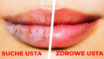 7 sposobów na problemy z opryszczką i suchymi wargami. Naturalnie i bez bólu