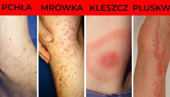 Jak rozpoznać ukąszenia owadów – 8 rodzajów popularnych ugryzień