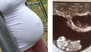 Była w ciąży z bliźniętami. Niestety jeden z maluszków „zniknął” z jej brzucha