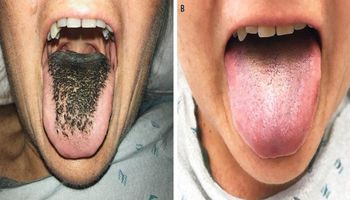 Czarny język włochaty to dolegliwość, której nabawiła się jedna z pacjentek po zażyciu antybiotyków