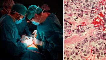 Cztery osoby zostały „zarażone” rakiem podczas przeszczepu organów pochodzących od jednego dawcy