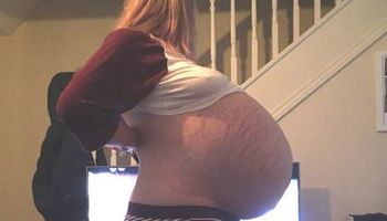 „Ciążowy brzuch” kobiety okazał się być 25-kilogramową cystą na jajniku