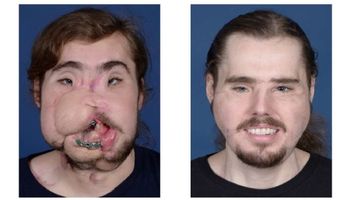 Niewiarygodna poprawa pacjenta zaledwie rok po kompletnym przeszczepie twarzy