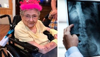 Kobieta przeżyła 99 lat z narządami w niewłaściwych miejscach. Nie miała o tym pojęcia
