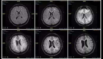 Lekarze udostępniają zdjęcia, które pokazują wpływ kokainy na mózg człowieka