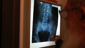 Ku zaskoczeniu lekarzy, rentgen ujawnił, że penis pacjenta dosłownie zamienia się w kość