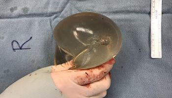 Kobieta zdecydowała się na sztuczny biust. Implant piersi uratował jej życie