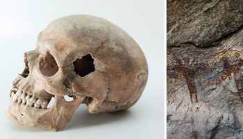 Pierwsza trepanacja czaszki miała miejsce w prehistorii. O dziwo pacjent przeżył