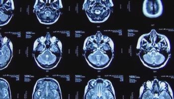 Wielu pacjentów z COVID-19 doświadcza problemów neurologicznych, ujawniają skany mózgu
