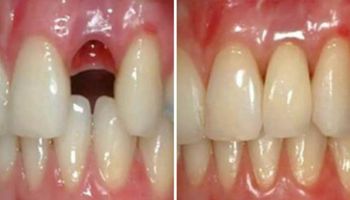 Naukowcy znaleźli sposób na „wyhodowanie” nowych zębów. Bez wywoływania skutków ubocznych