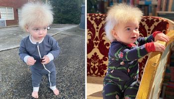 Chłopiec jest jedną ze 100 żyjących osób z zespołem nieuczesanych włosów