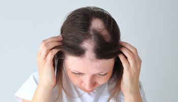 Czym właściwie jest łysienie plackowate? Skąd bierze się ta przykra przypadłość i jak ją leczyć