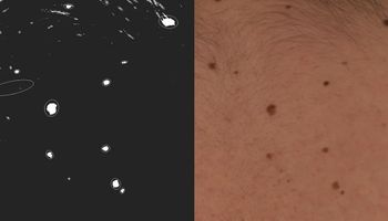 Narzędzie astronomiczne jest wykorzystywane w celu diagnozowania raka skóry
