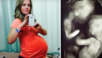 Ta kobieta była w ciąży z bliźniakami. Na jednym z ostatnich USG lekarz zobaczył coś niepokojącego