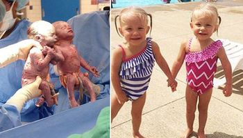 Tuż po narodzinach zszokowały cały personel medyczny. Te bliźniaczki są wyjątkowe!
