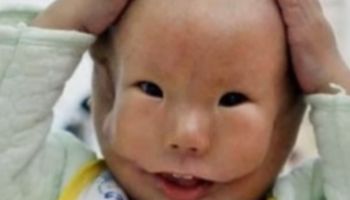 W Chinach urodził się chłopiec z podwójną twarzą. Lekarze chcę przeprowadzić poważną operację, aby poprawić jego wygląd