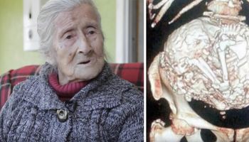 Lekarz odkrył w brzuchu 60-letniej kobiety guza. Jak się okazało było to jej nienarodzone dziecko