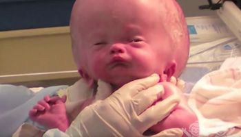 Chłopiec urodził się z ogromnym obrzękiem głowy. Wystarczyła jedna operacja, aby całkowicie zmienić jego wygląd