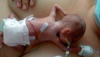 Urodziła się w szóstym miesiącu ciąży i przez kilka miesięcy dzielnie walczyła o życie