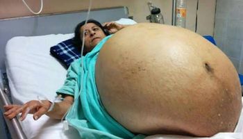 Kobieta przez pięć lat nie odwiedzała lekarza, aż trafiła do szpitala z guzem, który ważył aż 60 kg!