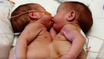 Te syjamskie bliźniaczki urodziły się z połączonymi brzuszkami. Lekarze nie dawali rodzicom nadziei