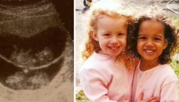 Badanie USG pokazywało, że bliźniaczki urodzą się normalne. Ale mama była wstrząśnięta, gdy je zobaczyła