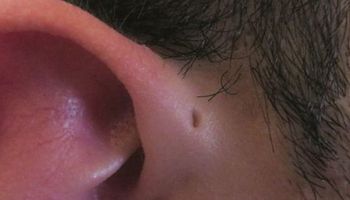Jeżeli masz tę małą dziurkę tuż nad uchem, to prawdopodobne powstała właśnie z tego powodu