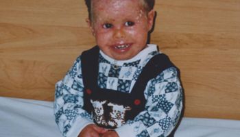 Ten chłopiec cierpi na ekstremalnie rzadką chorobę skóry. W leczeniu pomaga mu 300 małych stworzeń