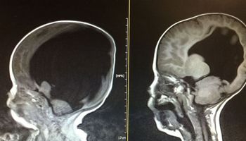 Urodził się z zanikiem mózgu. Gdy lekarze po 3 latach prześwietlili jego głowę, uznali to za cud