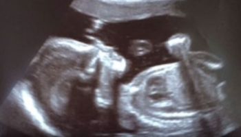Podczas badania USG widać białą poświatę wokół główki dziecka. Gdy się rodzi, mówi o niej cały szpital!