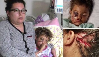 5-latka została zaatakowana przez dwa pitbule. Jej mama w akcie desperacji osłoniła ją swoim ciałem