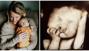 Lekarze proponowali aborcję, ale rodzice się nie zgodzili. Chłopiec urodził się z dużą deformacją.