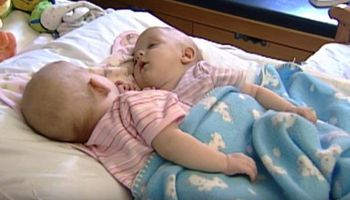 10 lat temu te syjamskie bliźniaczki zostały rozdzielone. Dzisiaj trudno jest je rozpoznać