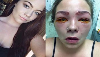 16-latka prawie straciła wzrok. Wszystko z powodu kosmetyku, którego używa większość kobiet!