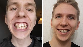 15 osób, które przekonają Cię, że aparat ortodontyczny potrafi zdziałać prawdziwe cuda!