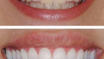 5 szybkich kroków do uzdrowienia zębów i naprawy ich ubytków. To prostsze niż myślisz!